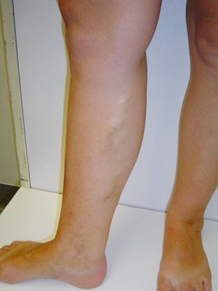 Are ankle and foot veins linked to deeper vein problems?
