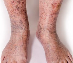 Varicose Veins - Symptoms, Causes & Conditions | Vein Health