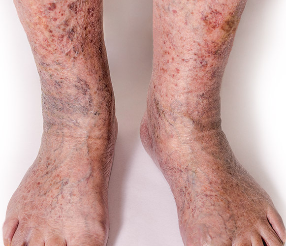 Early Warning Signs of Chronic Venous Insufficiency - Vein Solutions