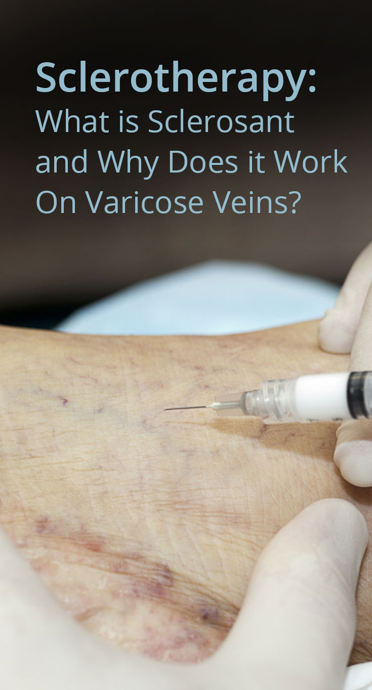 Sclerotherapy: What is Sclerosant and Why Does it Work On Varicose ...