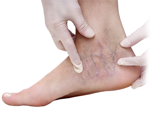 Dealing with Spider Veins on Ankles and Feet