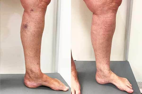 Before and After - Spider Veins  Vein Health Clinic Melbourne