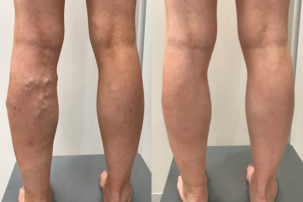 Vein Treatment Case Study - 40-year-old with Varicose Veins