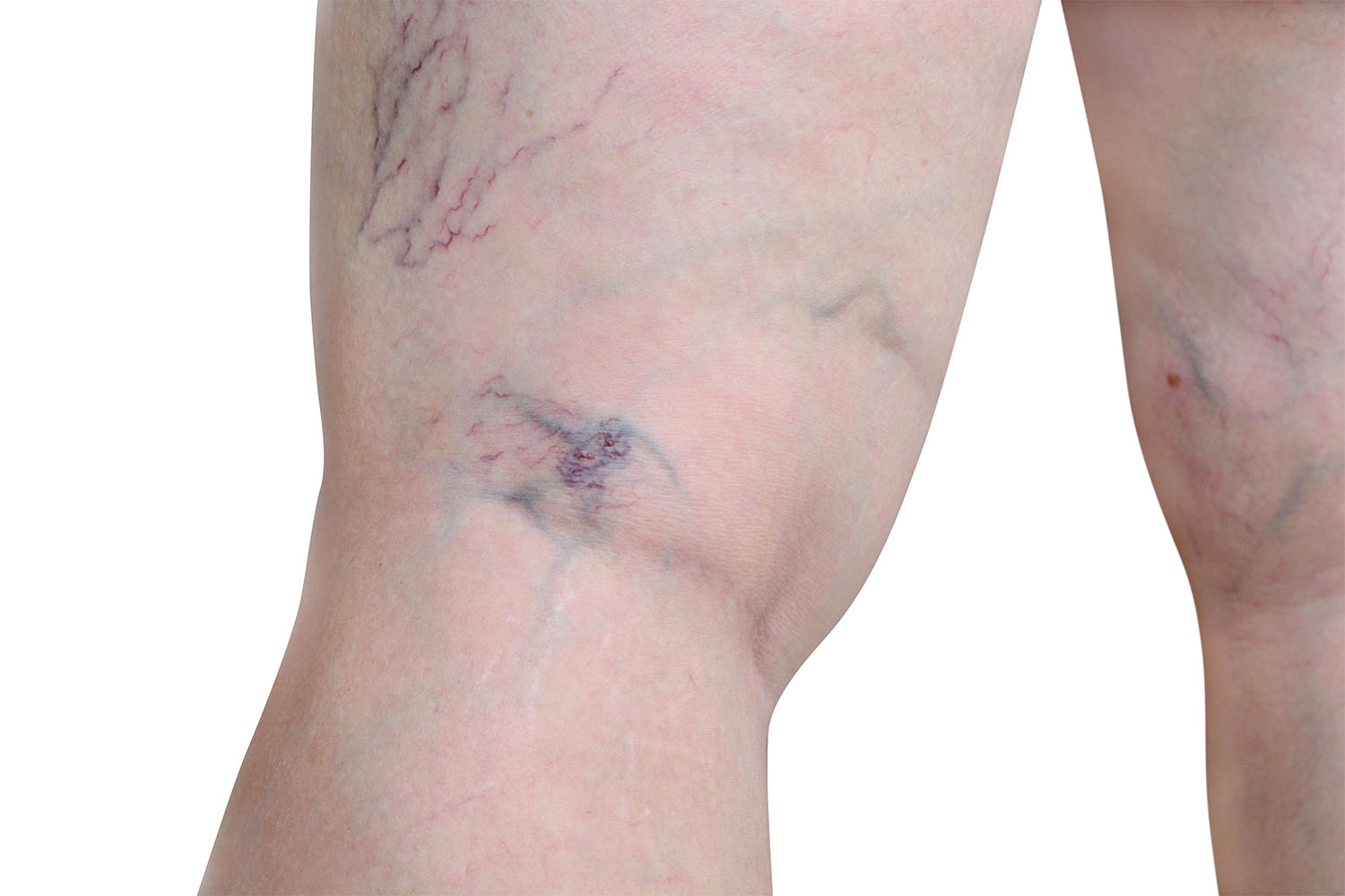 What Are Spider Veins  How To Get Rid of Them  CVR