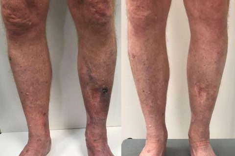 Patient Case Study: A Closer Look At Venous Ulcers