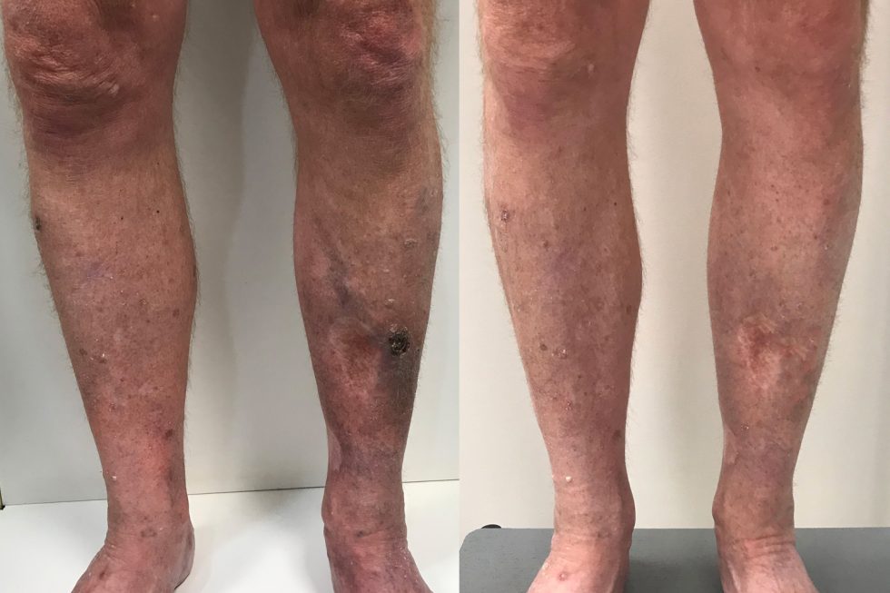 Patient Case Study A Closer Look At Venous Ulcers