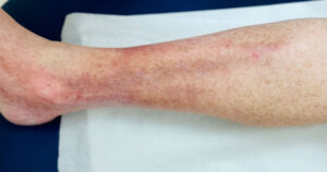 A lower leg showing signs of inflammation and redness, with a visible rash on a light-colored skin tone, resting on a white medical paper sheet.