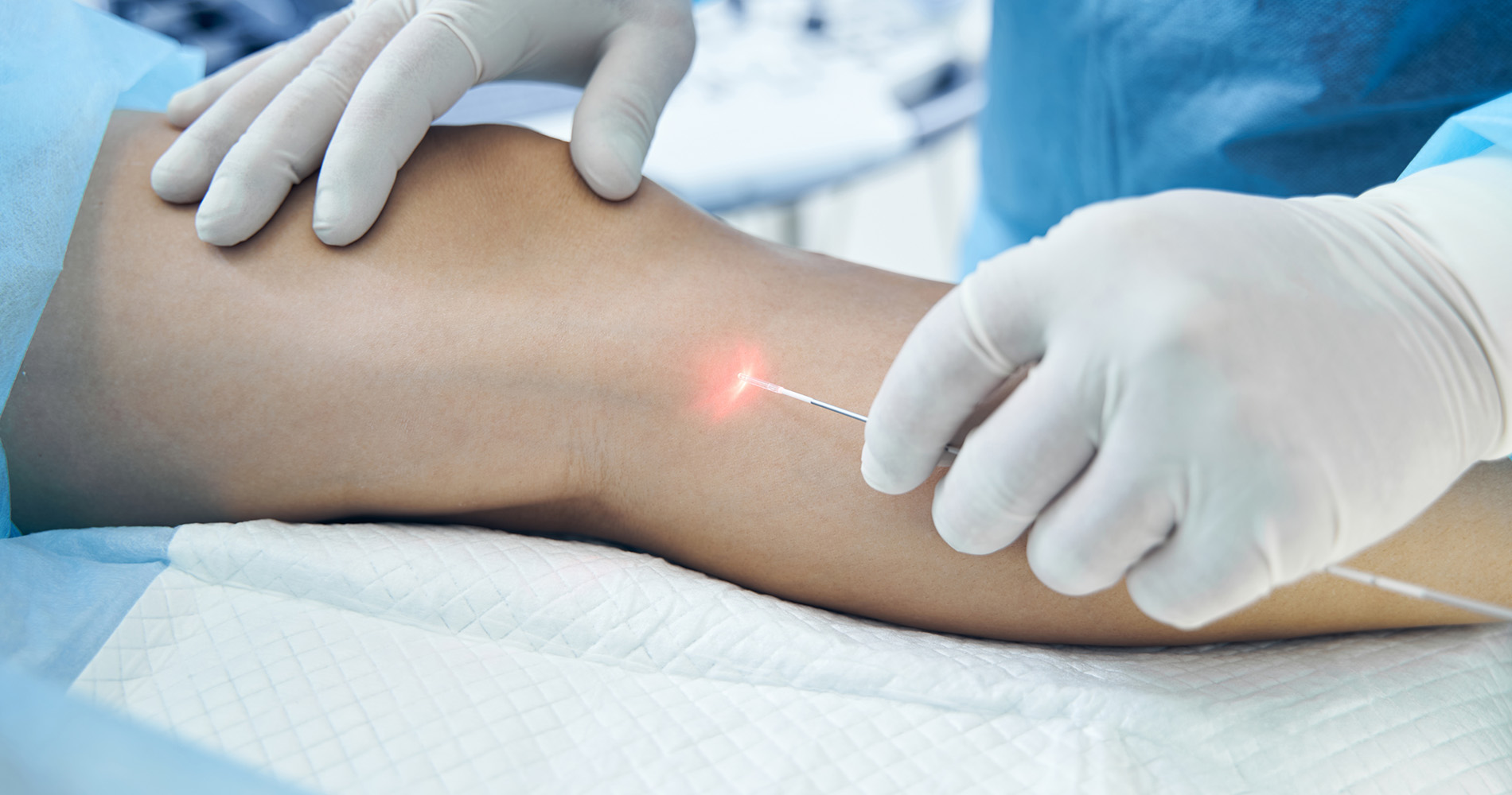 A medical professional performs a laser procedure on a patient's leg, using a fiber optic tool under sterile conditions.