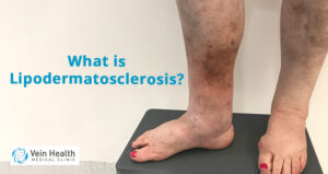 A person's lower legs and feet with visible skin discoloration and swelling. Text on image reads: "What is Lipodermatosclerosis?"