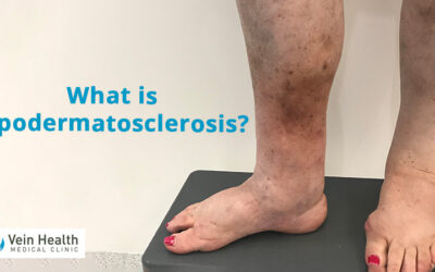 Lipodermatosclerosis & Advanced Venous Disease