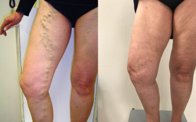 Patient Case Study: 18 Years Varicose Vein-Free